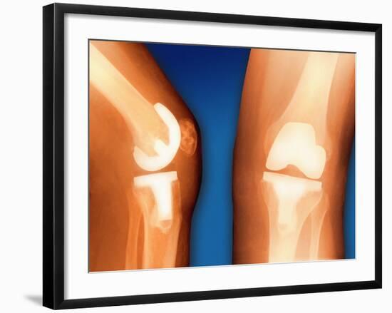 Prosthetic Knee Joint, Coloured X-ray-Miriam Maslo-Framed Photographic Print