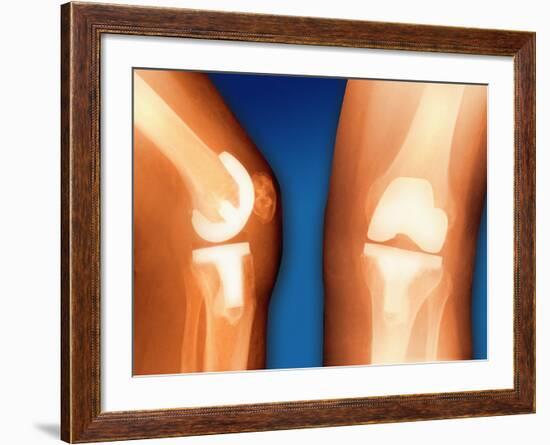 Prosthetic Knee Joint, Coloured X-ray-Miriam Maslo-Framed Photographic Print