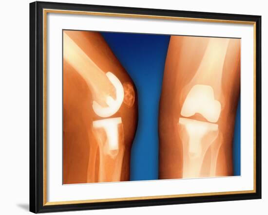 Prosthetic Knee Joint, Coloured X-ray-Miriam Maslo-Framed Photographic Print