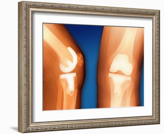 Prosthetic Knee Joint, Coloured X-ray-Miriam Maslo-Framed Photographic Print
