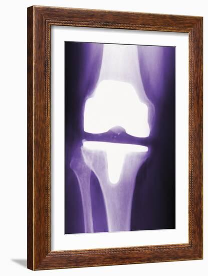 Prosthetic Knee, X-ray-Miriam Maslo-Framed Photographic Print