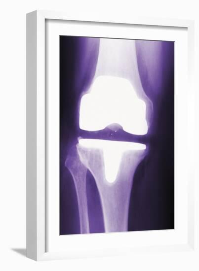 Prosthetic Knee, X-ray-Miriam Maslo-Framed Photographic Print