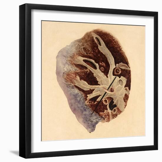 Pulmonary Clot, Illustration, 1844-Science Source-Framed Giclee Print