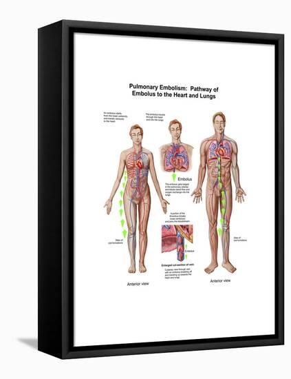 Pulmonary Embolism, Pathway of Embolus to the Heart and Lungs-null-Framed Stretched Canvas