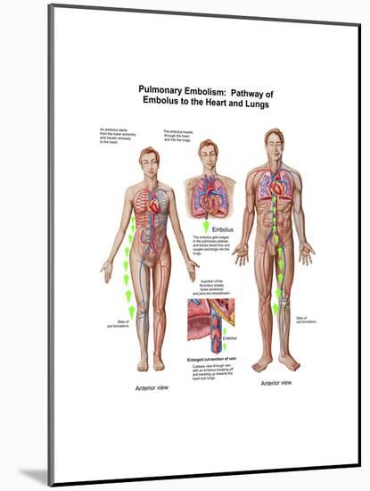 Pulmonary Embolism, Pathway of Embolus to the Heart and Lungs-null-Mounted Art Print