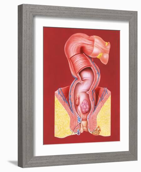 Rectal Disorders-John Bavosi-Framed Photographic Print