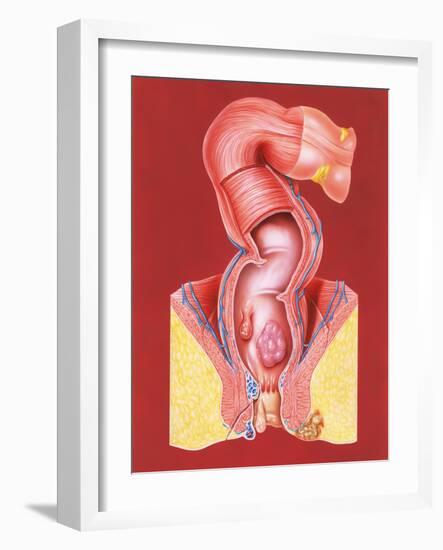 Rectal Disorders-John Bavosi-Framed Photographic Print