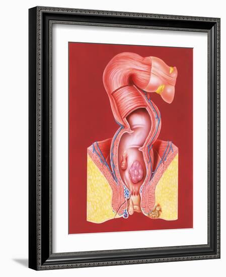 Rectal Disorders-John Bavosi-Framed Photographic Print