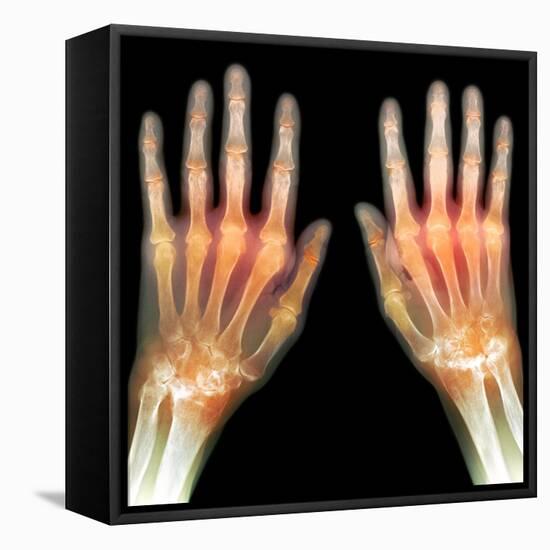 Rheumatoid Arthritis of the Hands, X-ray-Du Cane Medical-Framed Premier Image Canvas