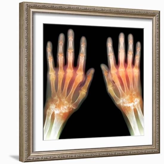 Rheumatoid Arthritis of the Hands, X-ray-Du Cane Medical-Framed Premium Photographic Print