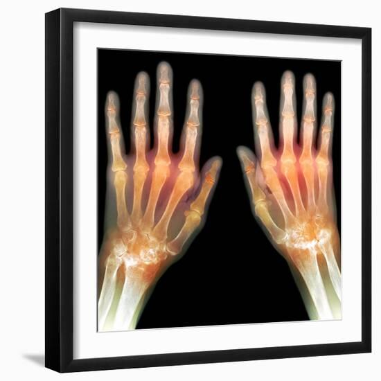 Rheumatoid Arthritis of the Hands, X-ray-Du Cane Medical-Framed Premium Photographic Print