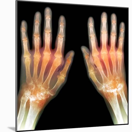 Rheumatoid Arthritis of the Hands, X-ray-Du Cane Medical-Mounted Premium Photographic Print