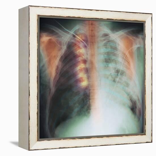 Rib Fracture, X-ray-PHT-Framed Premier Image Canvas