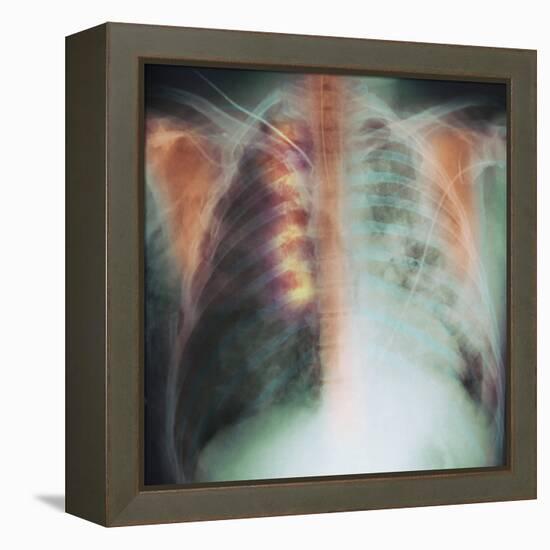 Rib Fracture, X-ray-PHT-Framed Premier Image Canvas