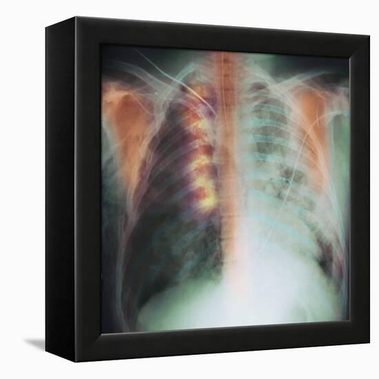 Rib Fracture, X-ray-PHT-Framed Premier Image Canvas