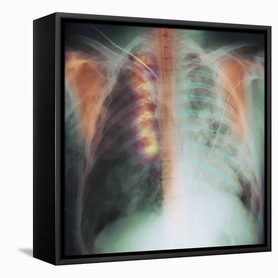 Rib Fracture, X-ray-PHT-Framed Premier Image Canvas