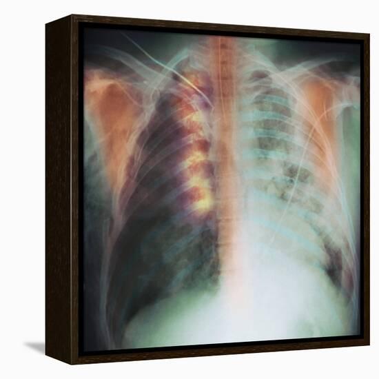 Rib Fracture, X-ray-PHT-Framed Premier Image Canvas