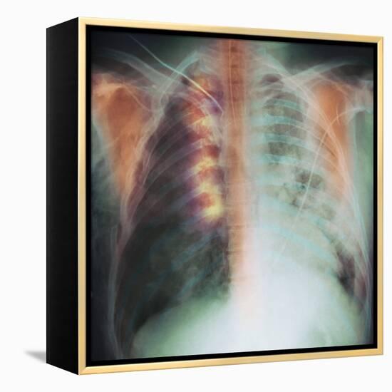 Rib Fracture, X-ray-PHT-Framed Premier Image Canvas