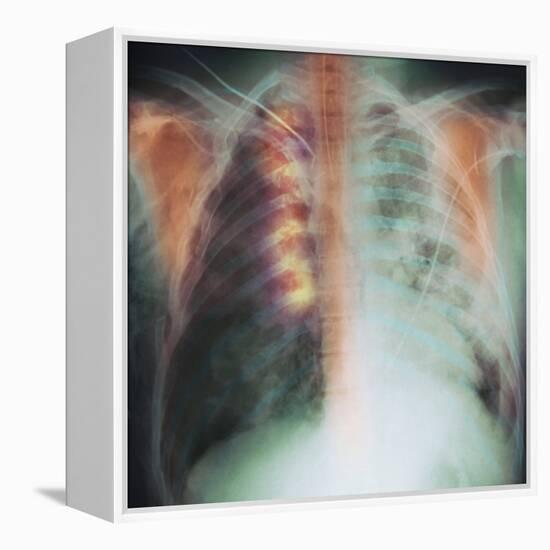 Rib Fracture, X-ray-PHT-Framed Premier Image Canvas