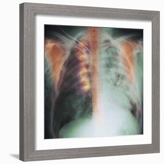 Rib Fracture, X-ray-PHT-Framed Premium Photographic Print