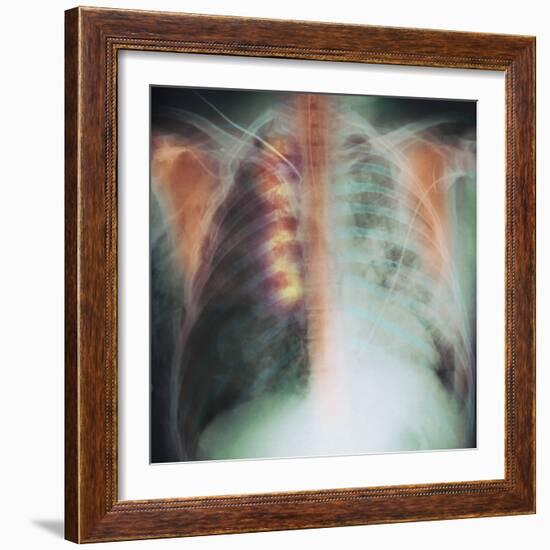 Rib Fracture, X-ray-PHT-Framed Premium Photographic Print