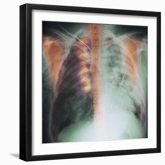 Rib Fracture, X-ray-PHT-Framed Premium Photographic Print