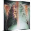 Rib Fracture, X-ray-PHT-Mounted Premium Photographic Print