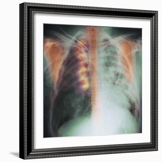 Rib Fracture, X-ray-PHT-Framed Premium Photographic Print