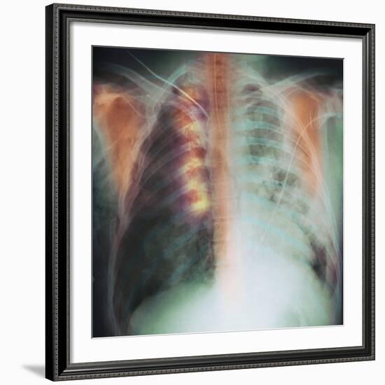 Rib Fracture, X-ray-PHT-Framed Photographic Print