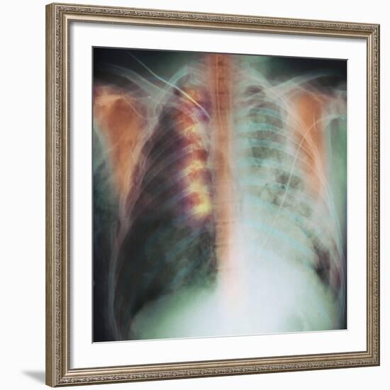 Rib Fracture, X-ray-PHT-Framed Photographic Print