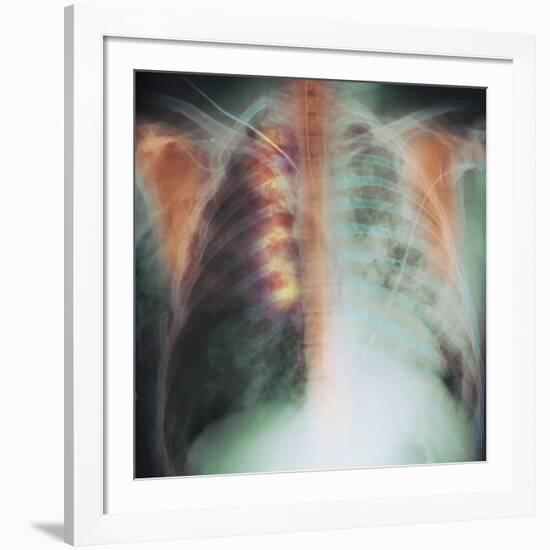 Rib Fracture, X-ray-PHT-Framed Photographic Print