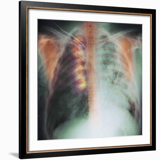 Rib Fracture, X-ray-PHT-Framed Photographic Print