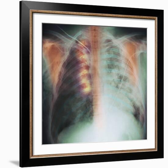 Rib Fracture, X-ray-PHT-Framed Photographic Print