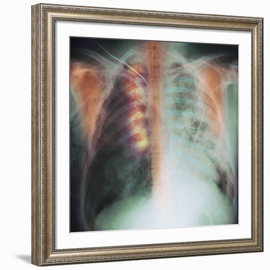 Rib Fracture, X-ray-PHT-Framed Photographic Print