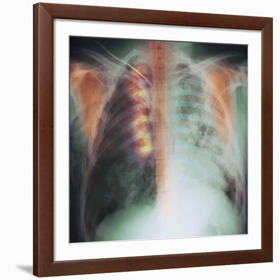 Rib Fracture, X-ray-PHT-Framed Photographic Print