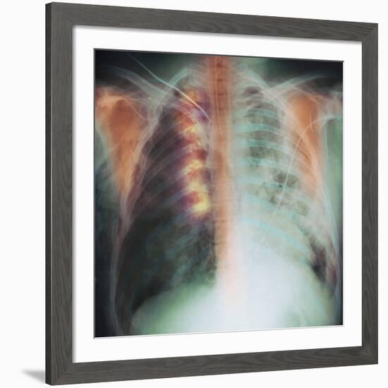 Rib Fracture, X-ray-PHT-Framed Photographic Print