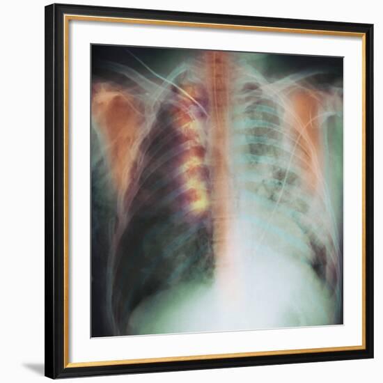 Rib Fracture, X-ray-PHT-Framed Photographic Print