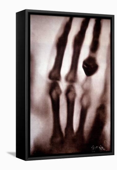 Roentgen Rays (Rontgen) or X-Rays First Photograph: the Hand of Roentgen's Wife. 22/12/1895.-Unknown Artist-Framed Premier Image Canvas