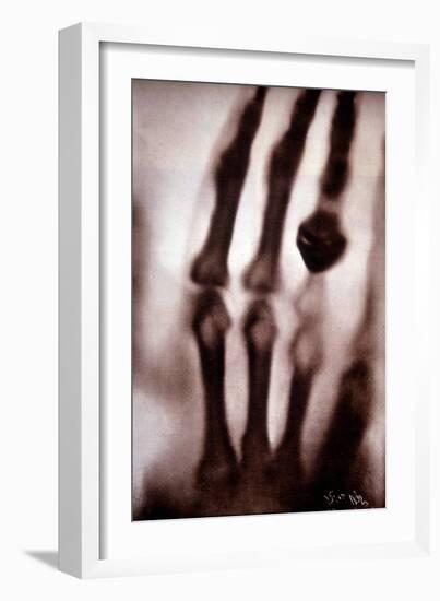 Roentgen Rays (Rontgen) or X-Rays First Photograph: the Hand of Roentgen's Wife. 22/12/1895.-Unknown Artist-Framed Giclee Print