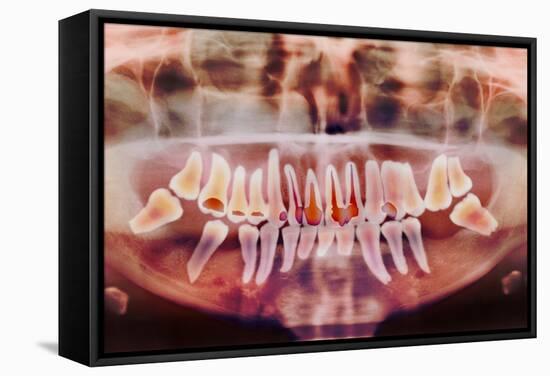 Root-canal Treatment, Dental X-ray-Science Photo Library-Framed Premier Image Canvas