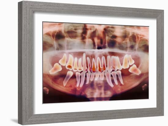 Root-canal Treatment, Dental X-ray-Science Photo Library-Framed Photographic Print