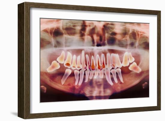 Root-canal Treatment, Dental X-ray-Science Photo Library-Framed Photographic Print