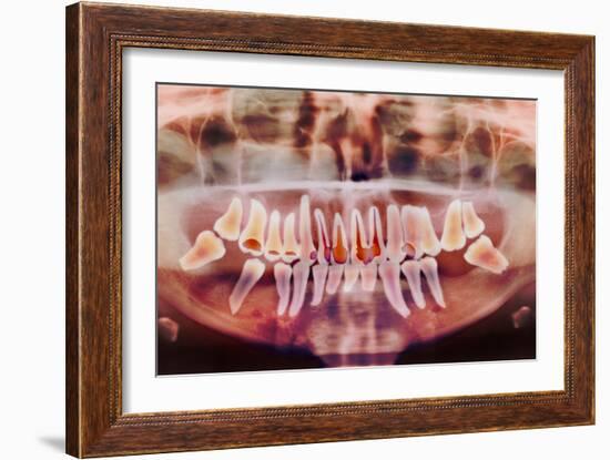 Root-canal Treatment, Dental X-ray-Science Photo Library-Framed Photographic Print