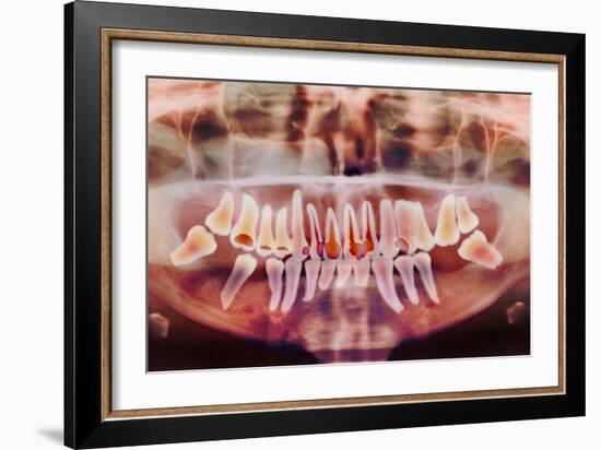 Root-canal Treatment, Dental X-ray-Science Photo Library-Framed Photographic Print