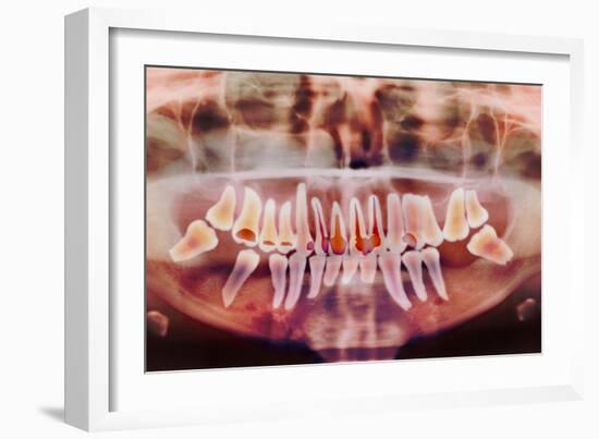 Root-canal Treatment, Dental X-ray-Science Photo Library-Framed Photographic Print