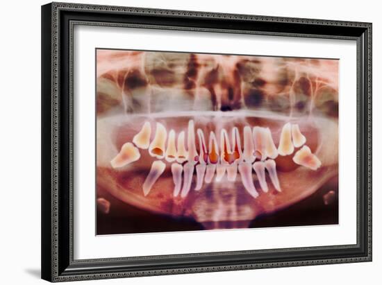 Root-canal Treatment, Dental X-ray-Science Photo Library-Framed Photographic Print