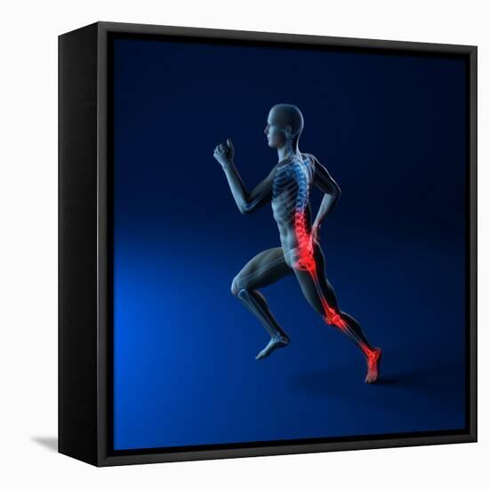 Running Injuries, Conceptual Artwork-SCIEPRO-Framed Premier Image Canvas