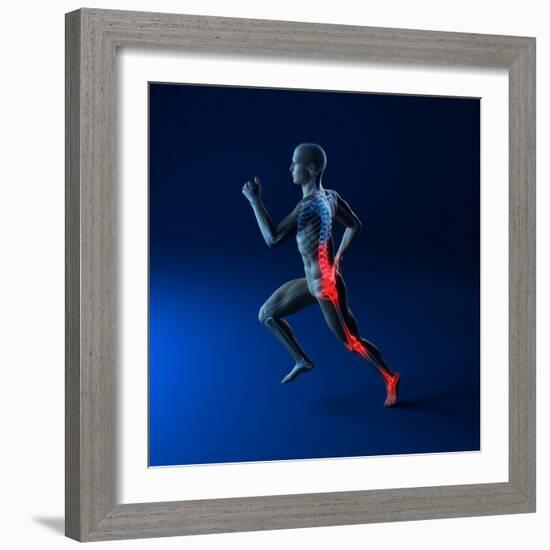 Running Injuries, Conceptual Artwork-SCIEPRO-Framed Premium Photographic Print