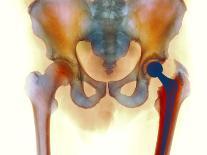 Osteoarthritis of Hip Joints, X-ray-Science Photo Library-Photographic Print