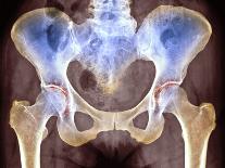 Hip Joint Replacement, X-ray-Science Photo Library-Photographic Print